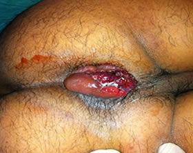 Tratamiento de hemorroides