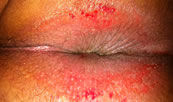 Dermatitis perianal en Chilpancingo
