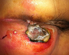 Tratamiento de absceso anal