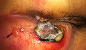 Tratamiento de absceso anal en Chilpancingo