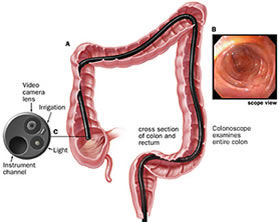 Colonoscopia para prevenir cáncer de colon y recto
