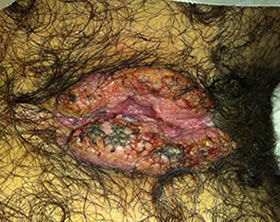 Tratamiento de condilomas anales