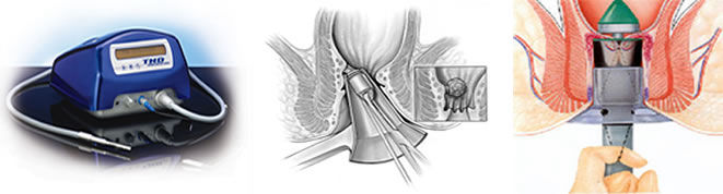 Tratamiento de hemorroides sin dolor